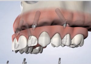 Illustration of all on 4 being attached to gums